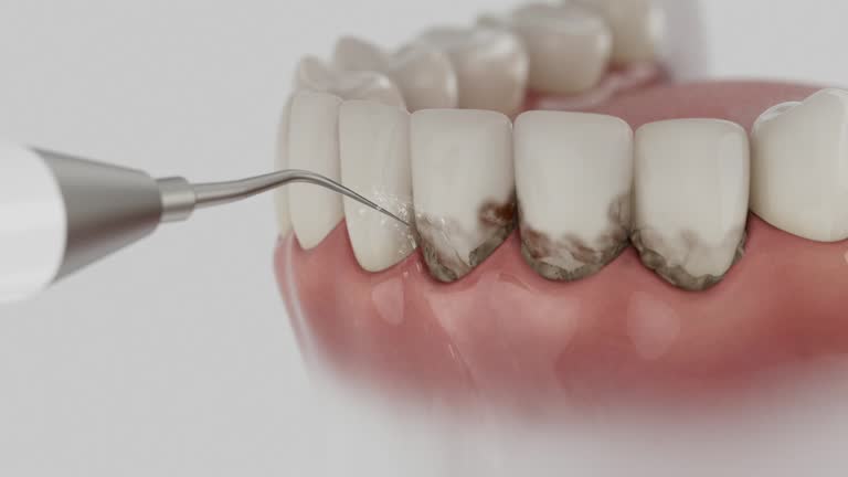 Trusted Wisdom Tooth Removal service in Palo Alto, CA - Dentist Open Now